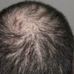 4 Awesome Guides for Choosing the Best Hair Transplant Clinic